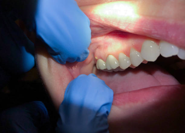 Best Emergency Wisdom Teeth Removal in Davenport, IA